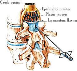 epiduralna injekcia